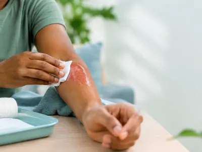 Burns: Types, Causes, Symptoms, and What to Do Immediately